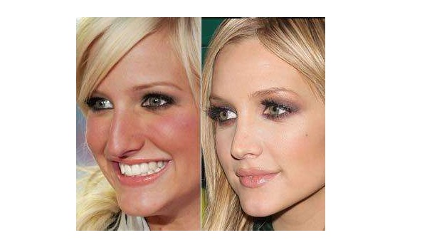 five-celebrities-who-have-had-a-nose-job